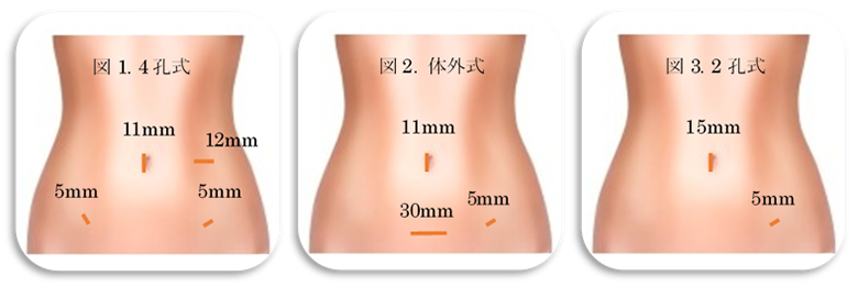 卵巣 嚢腫 痛み チクチク