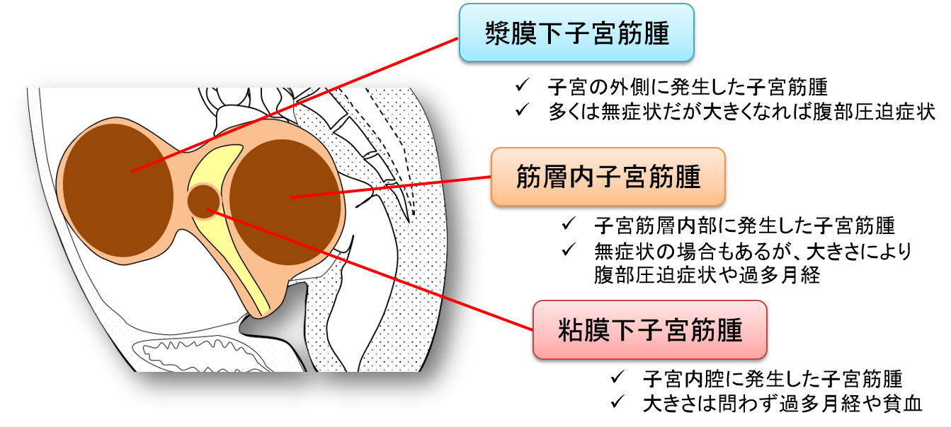 妊娠 中 子宮 筋腫