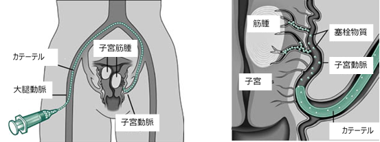 子宮動脈塞栓術