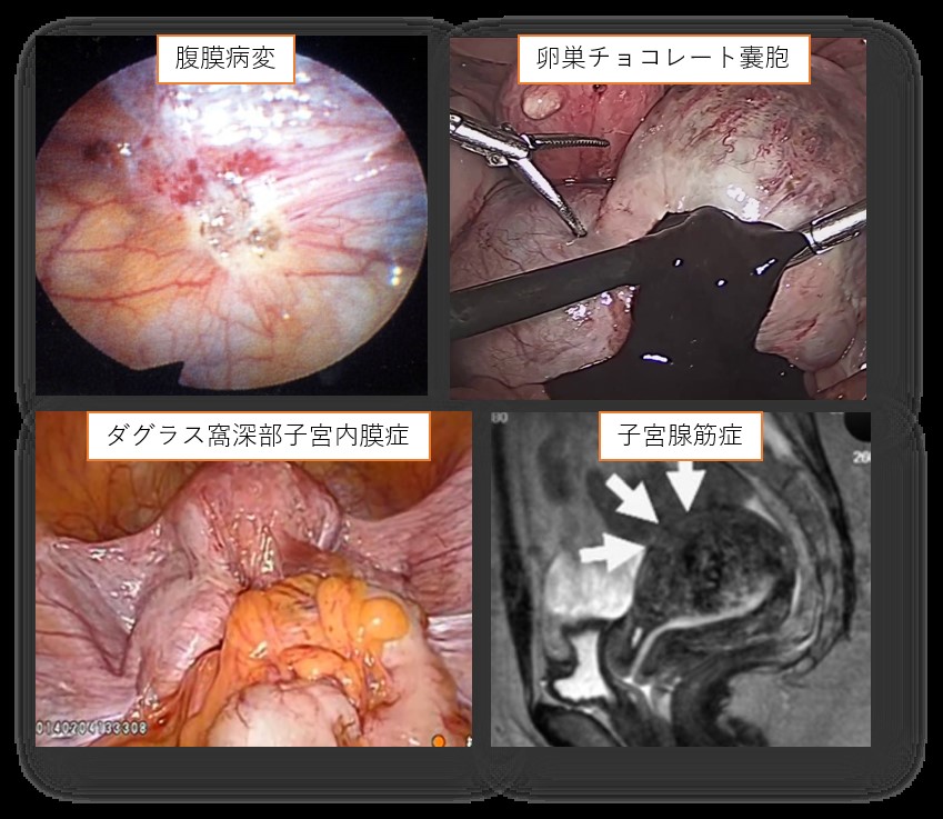 子宮筋腫とは