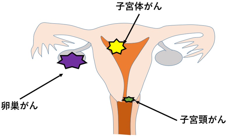 婦人科がん 図