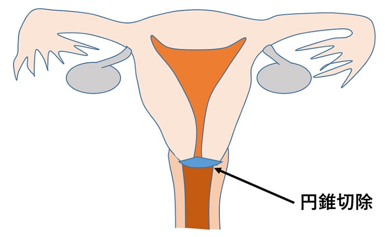 円錐 切除 術 と は
